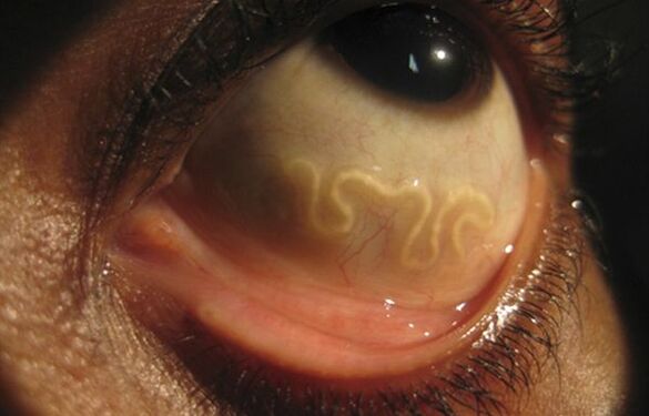 Το σκουλήκι loa loa ζει στο ανθρώπινο μάτι και προκαλεί τύφλωση